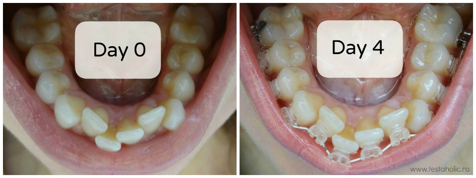 Mituri despre tratamentul cu aparat dentar - Clinica stomatologica Neoclinique