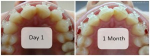 aparat-dentar-safir-transparent-inainte-dupa-poze